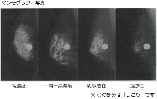 マンモグラフィ写真
